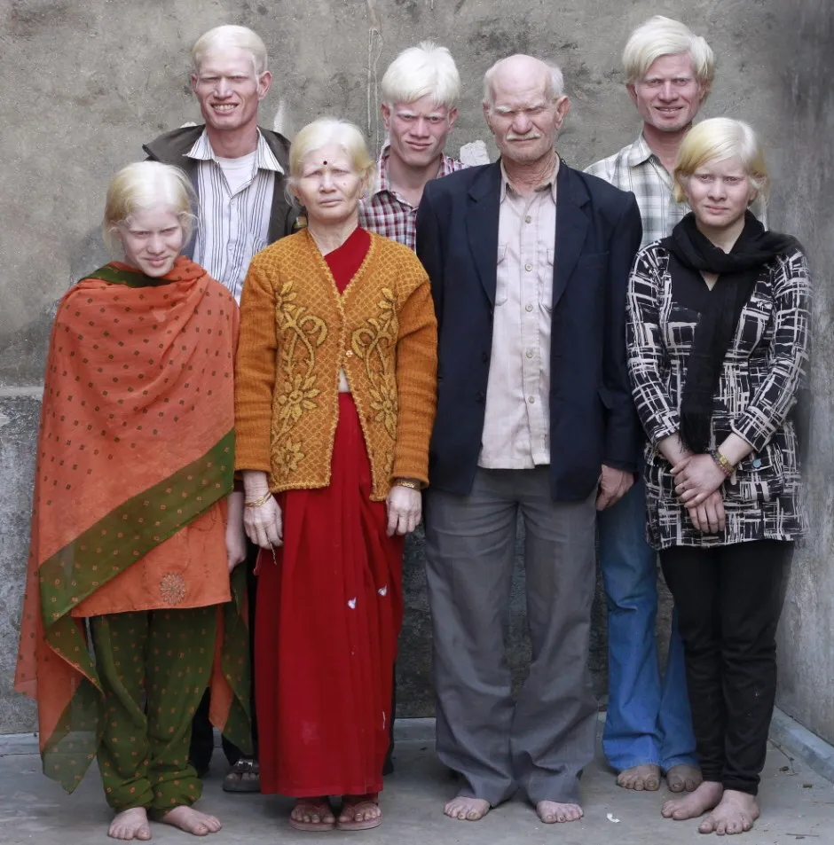 family of albino indians from india