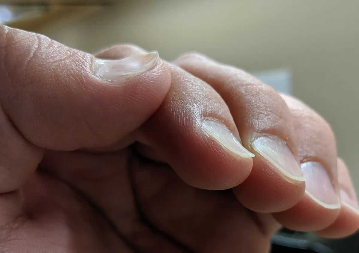 husband with inverted finger nails