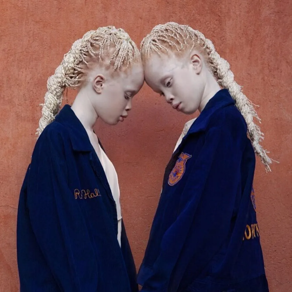 brazilian albino twins mara and lara