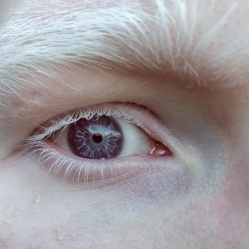 person with purple eyes who has albinoism