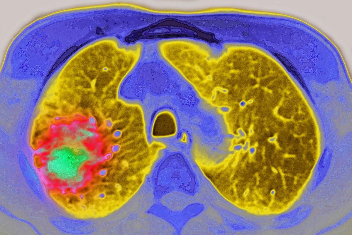 Lung cancer MRI.