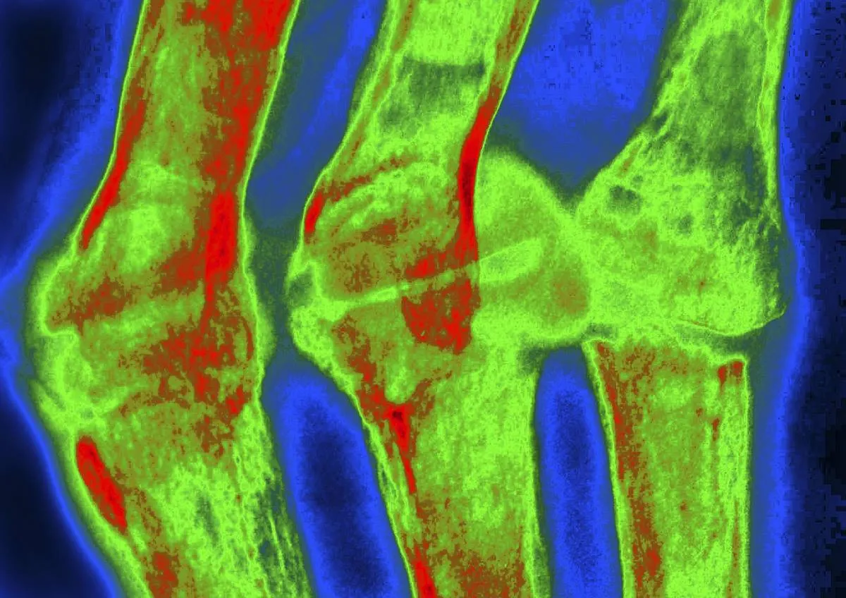 Rheumatoid Arthritis, X-Ray