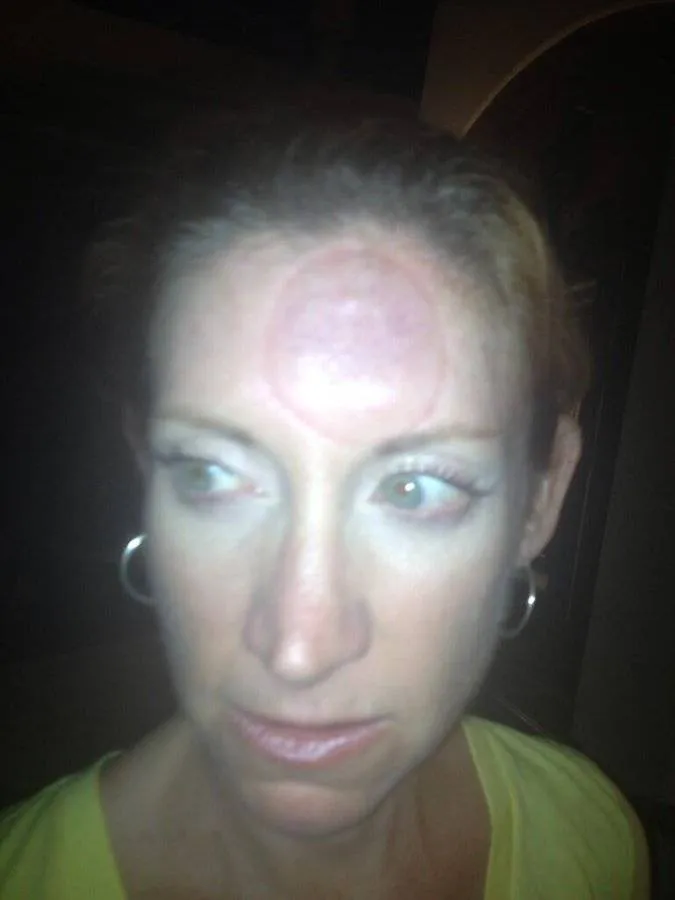 woman suction cup forehead